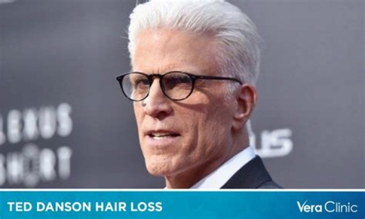 Pictures: Is Ted Danson Bald, What Happened To His Hair?