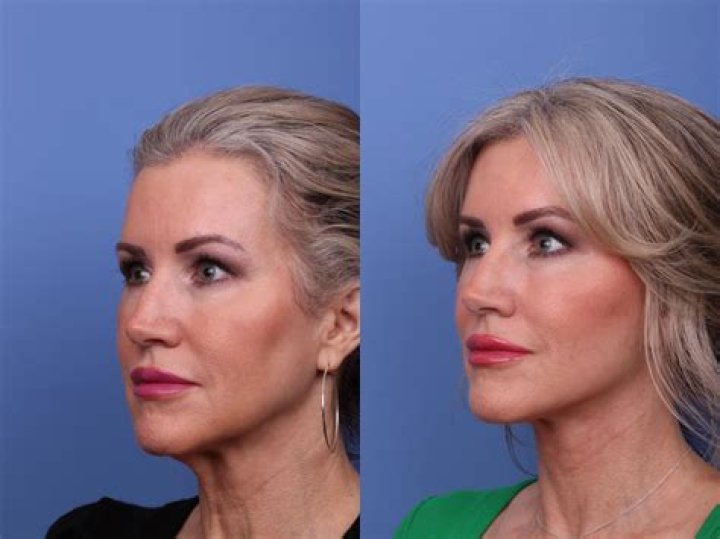 PJ Fleck’s Plastic Surgery: Facelift, Botox, Fillers & Eyelid Surgery!